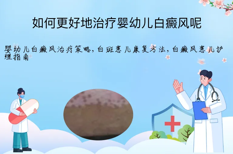 如何更好地治疗婴幼儿白癜风呢