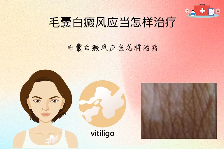 毛囊白癜风应当怎样治疗