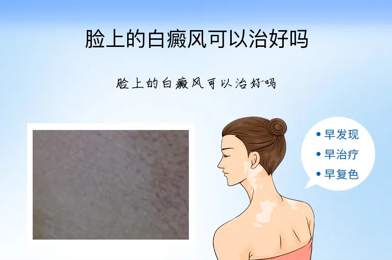 脸上的白癜风可以治好吗