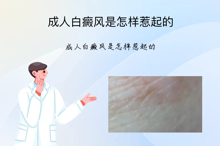 成人白癜风是怎样惹起的