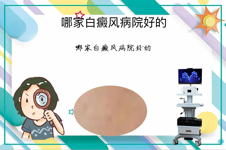 哪家白癜风病院好的