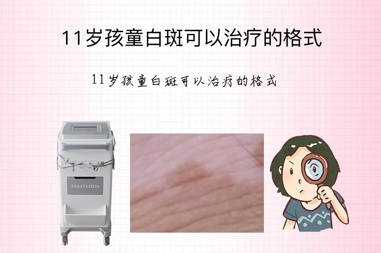 11岁孩童白斑可以治疗的格式