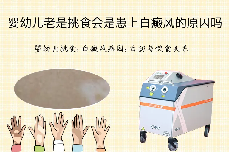 婴幼儿老是挑食会是患上白癜风的原因吗