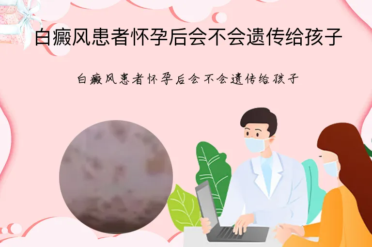 白癜风患者怀孕后会不会遗传给孩子