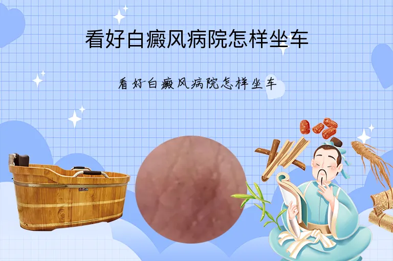 看好白癜风病院怎样坐车