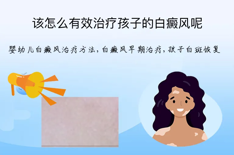 该怎么有效治疗孩子的白癜风呢