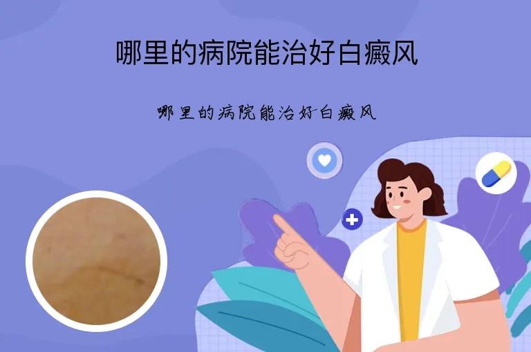 哪里的病院能治好白癜风