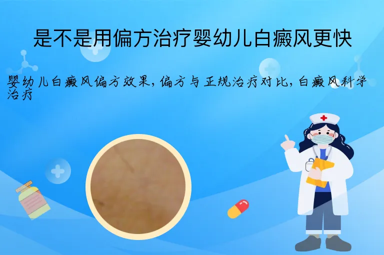 是不是用偏方治疗婴幼儿白癜风更快