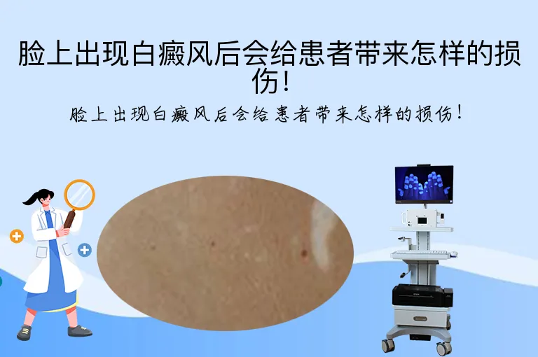 脸上出现白癜风后会给患者带来怎样的损伤！