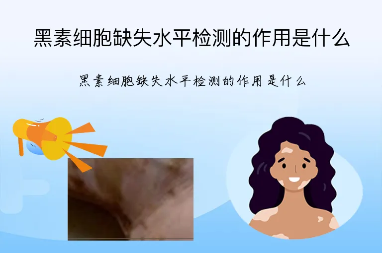 黑素细胞缺失水平检测的作用是什么
