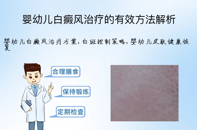 婴幼儿白癜风治疗的有效方法解析