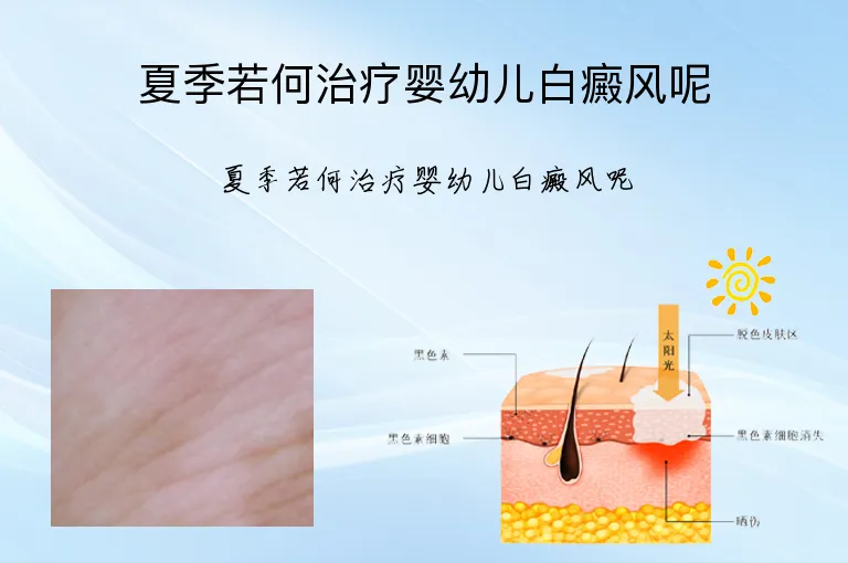 夏季若何治疗婴幼儿白癜风呢