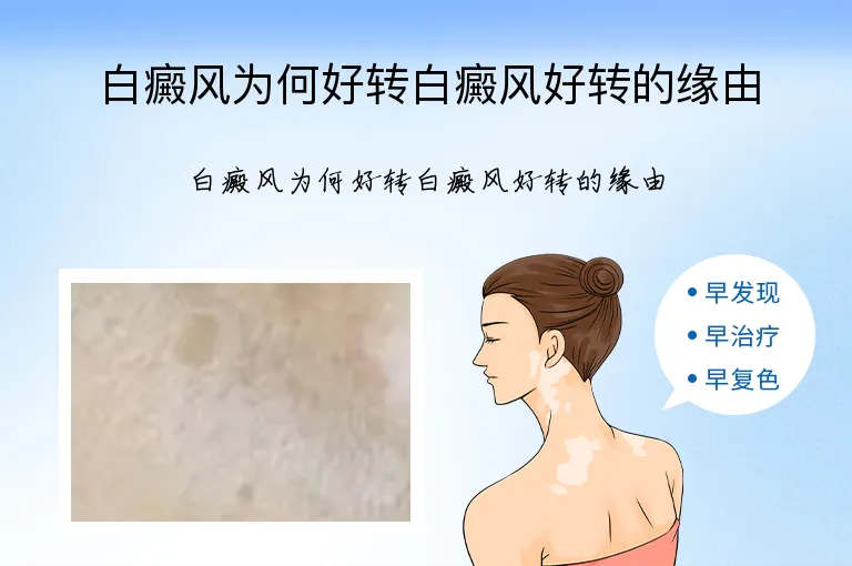 白癜风为何好转白癜风好转的缘由