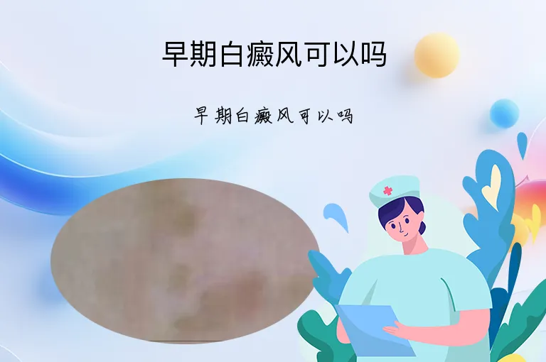 早期白癜风可以吗
