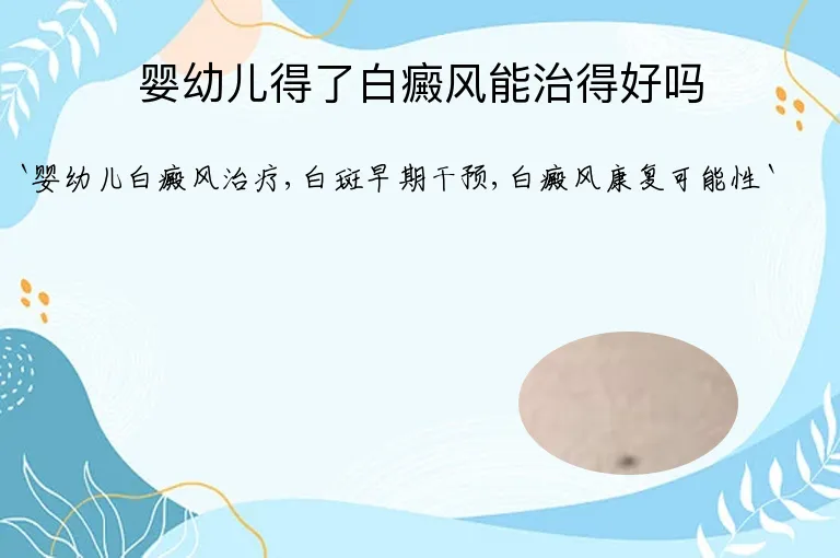 婴幼儿得了白癜风能治得好吗