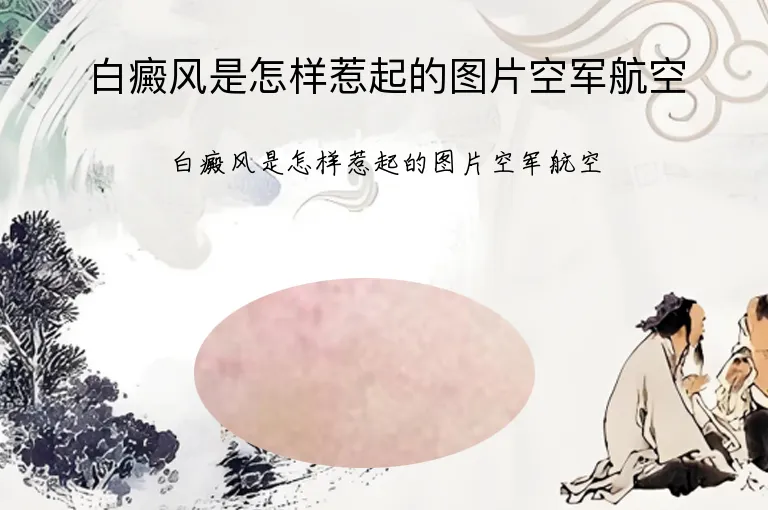 白癜风是怎样惹起的图片空军航空
