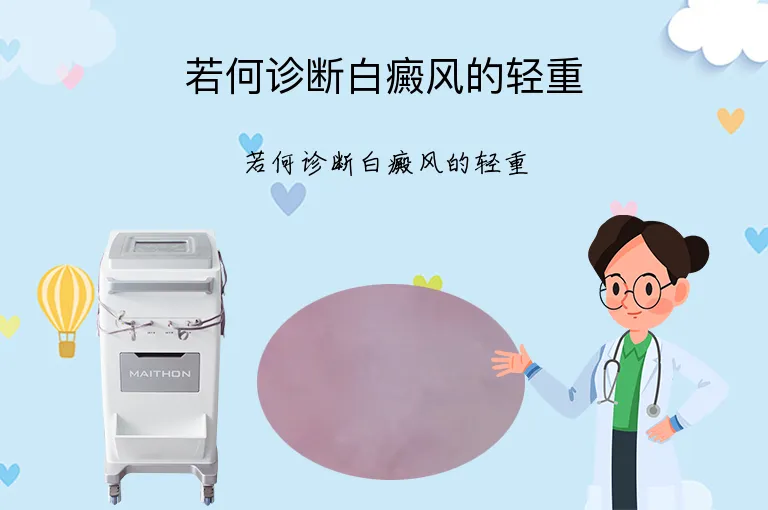 若何诊断白癜风的轻重