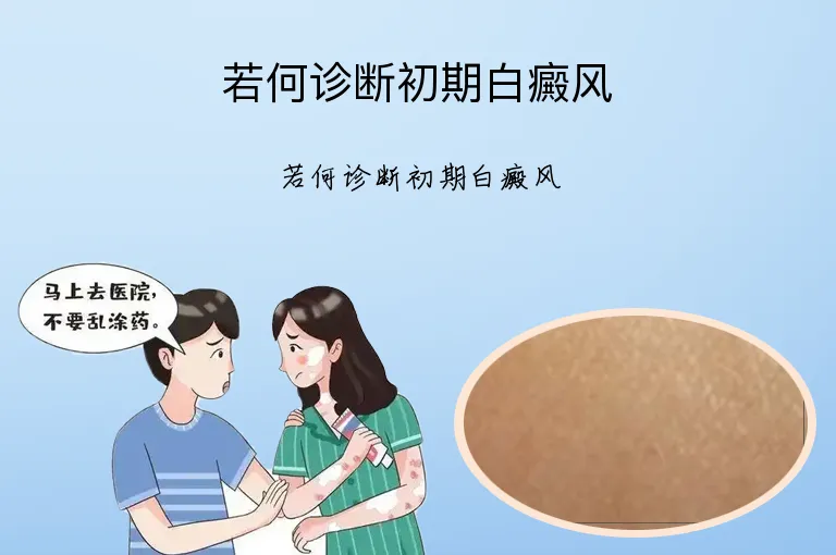 若何诊断初期白癜风