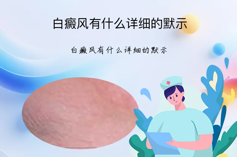白癜风有什么详细的默示