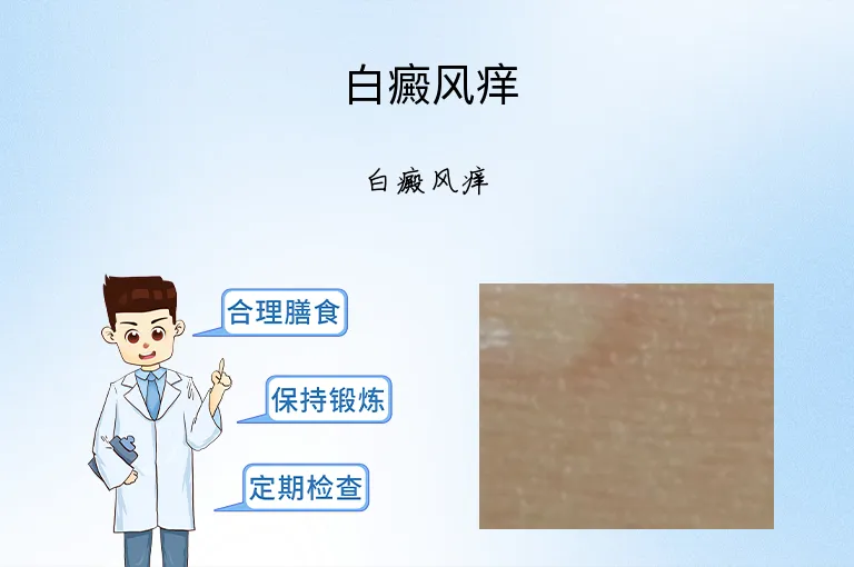 白癜风痒
