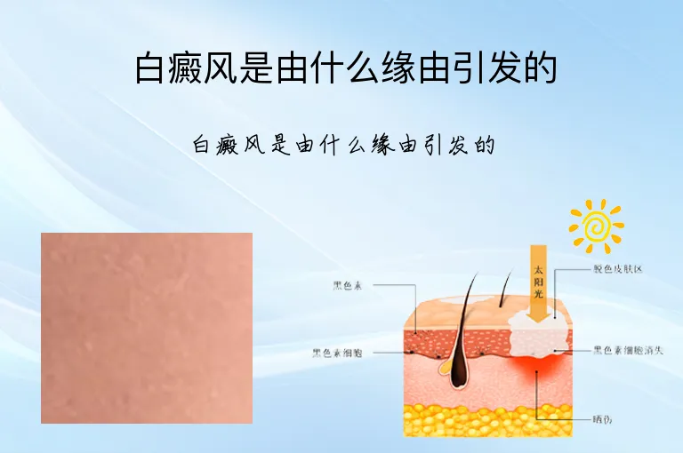 白癜风是由什么缘由引发的