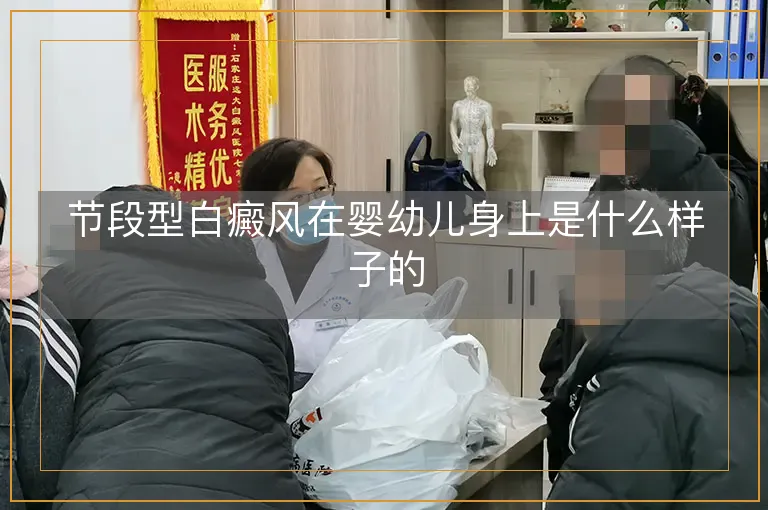 节段型白癜风在婴幼儿身上是什么样子的