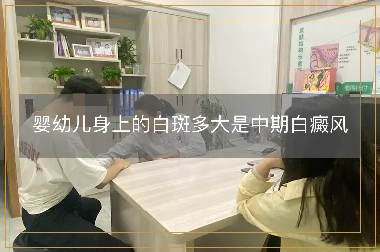 婴幼儿身上的白斑多大是中期白癜风