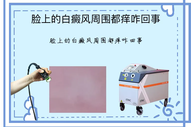 脸上的白癜风周围都痒咋回事