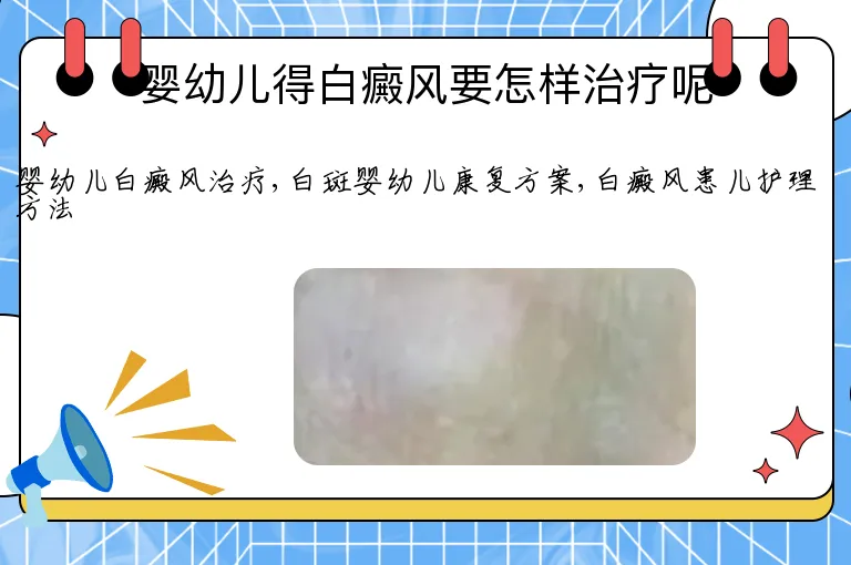 婴幼儿得白癜风要怎样治疗呢