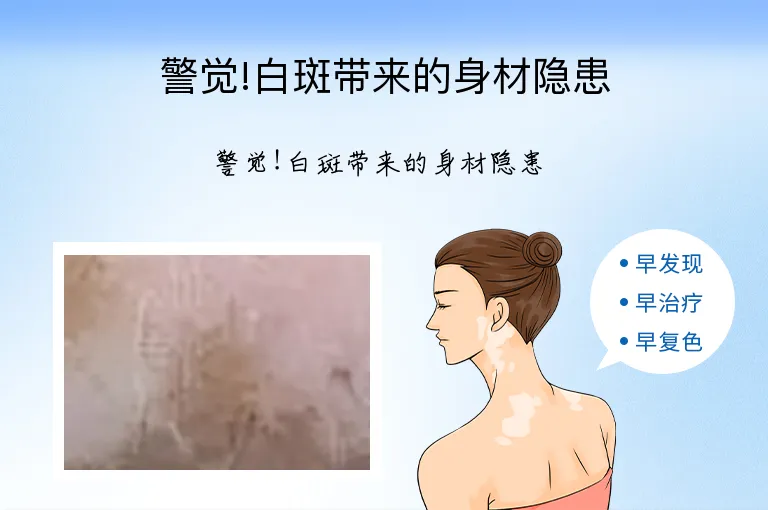 警觉!白斑带来的身材隐患