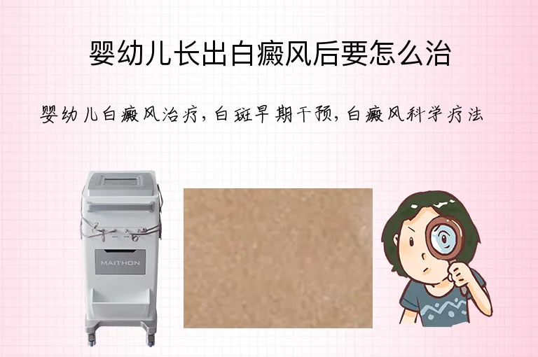 婴幼儿长出白癜风后要怎么治