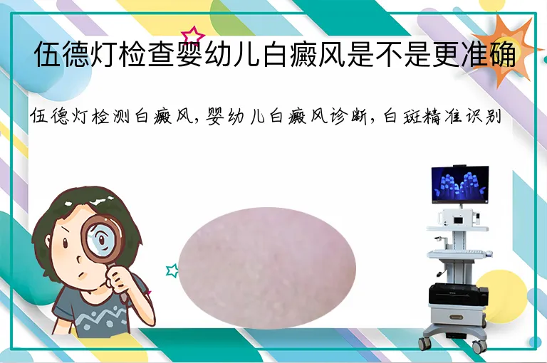 伍德灯检查婴幼儿白癜风是不是更准确