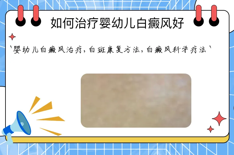 如何治疗婴幼儿白癜风好