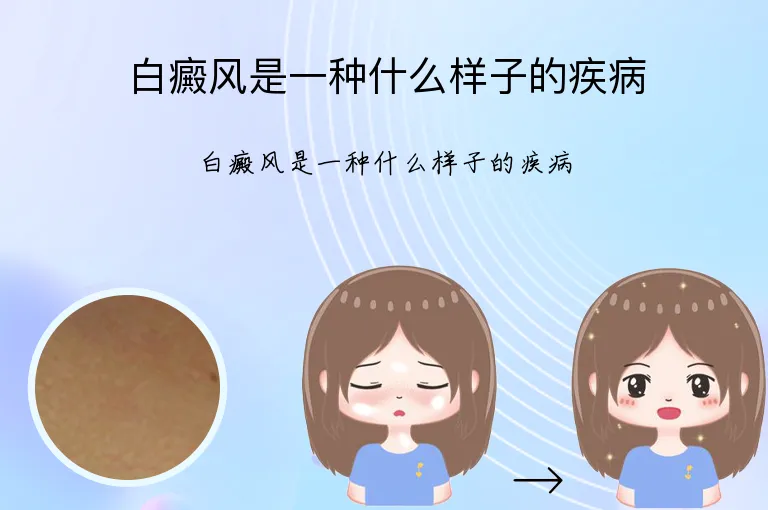 白癜风是一种什么样子的疾病