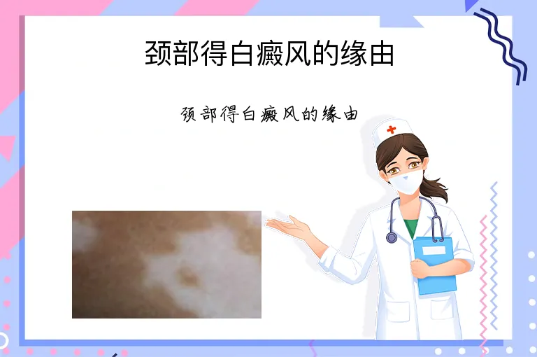 颈部得白癜风的缘由