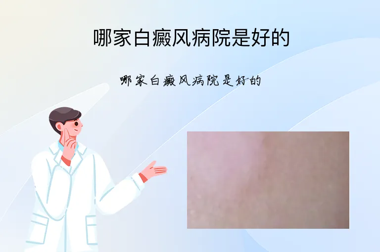 哪家白癜风病院是好的