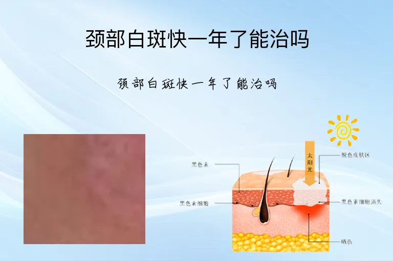 颈部白斑快一年了能治吗