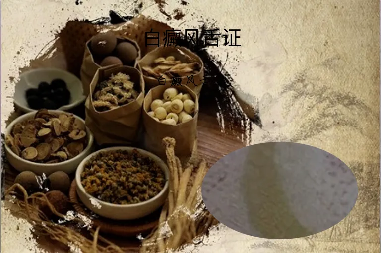 白癜风舌证