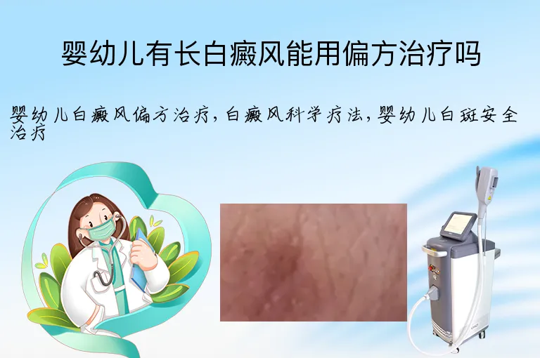 婴幼儿有长白癜风能用偏方治疗吗