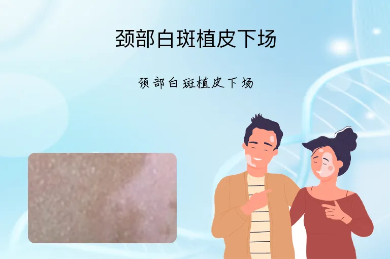 颈部白斑植皮下场