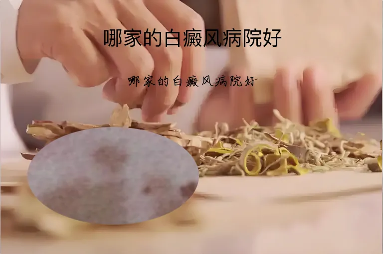 哪家的白癜风病院好
