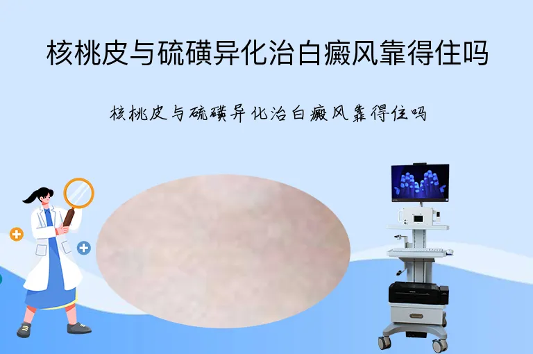 核桃皮与硫磺异化治白癜风靠得住吗