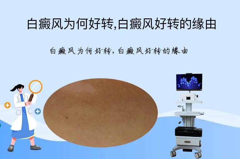 白癜风为何好转,白癜风好转的缘由