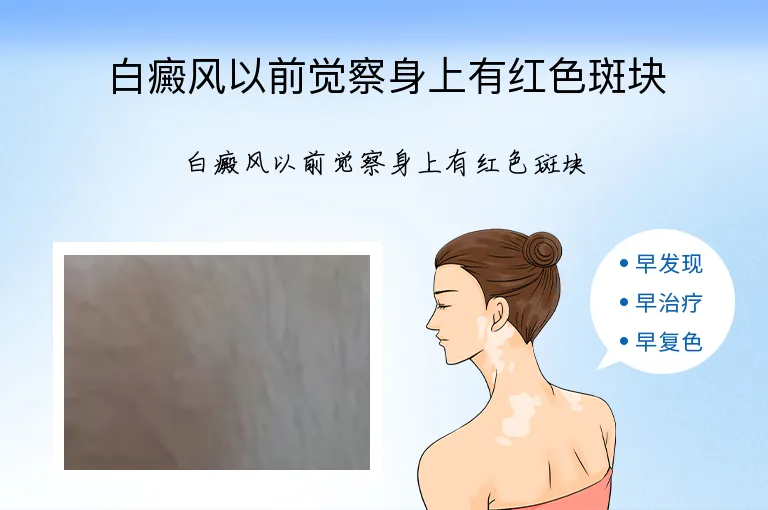白癜风以前觉察身上有红色斑块