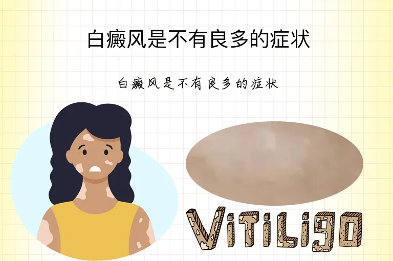 白癜风是不有良多的症状