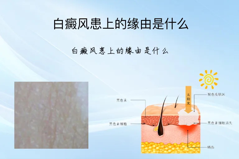 白癜风患上的缘由是什么