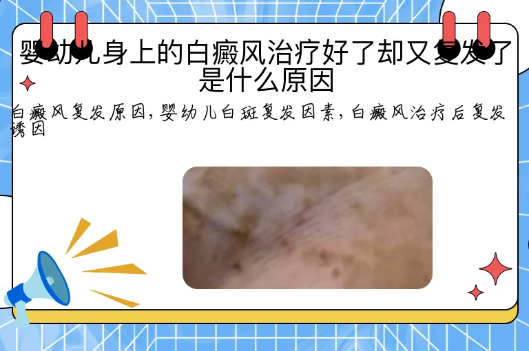 婴幼儿身上的白癜风治疗好了却又复发了是什么原因