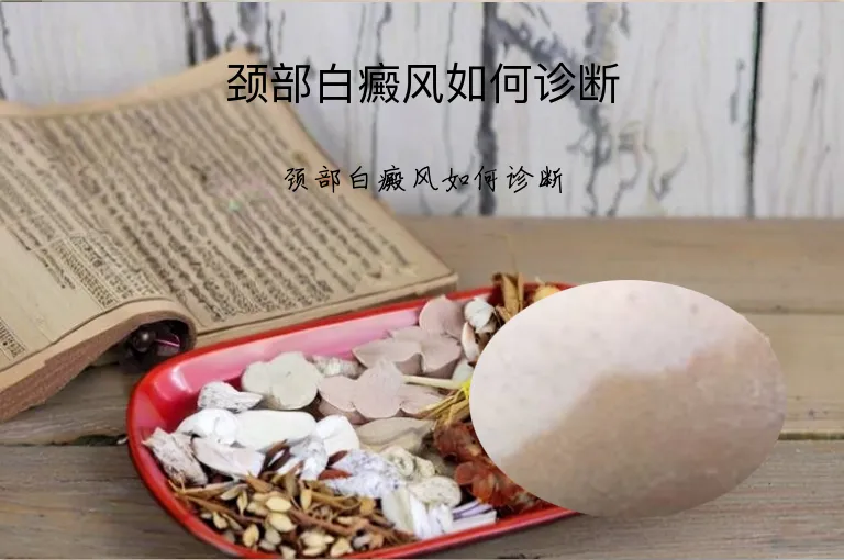 颈部白癜风如何诊断