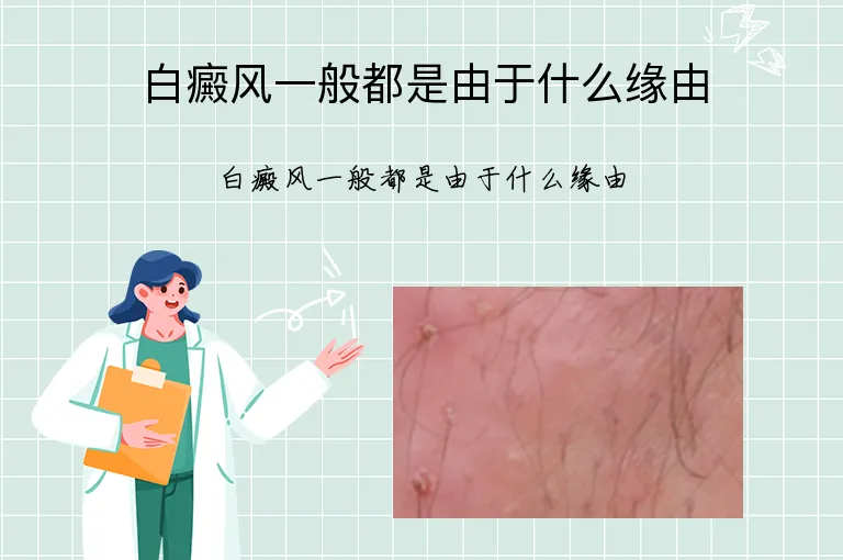 白癜风一般都是由于什么缘由
