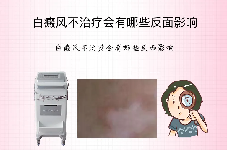 白癜风不治疗会有哪些反面影响